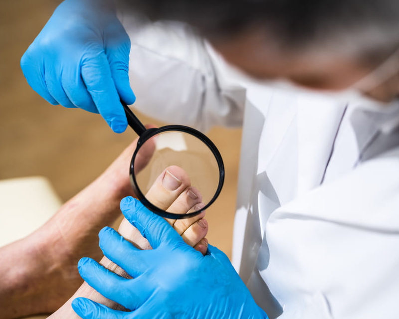 Вросший ноготь: причины, лечение и удаление