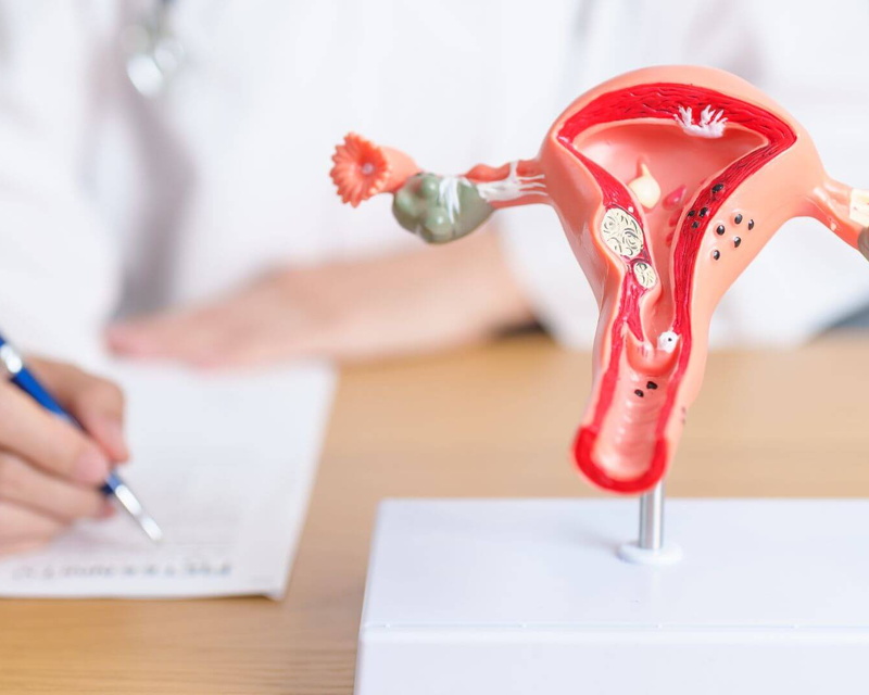 Миома матки: когда наблюдать, а когда лечить